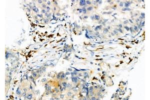 ABIN6264593 and ABIN6274042 at 1/100 staining Human pancreatic cancer by IHC-P. (RAB9A Antikörper  (Internal Region))