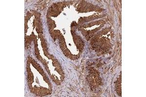 Immunohistochemical staining of human prostate with ALDH1A3 polyclonal antibody  shows strong cytoplasmic positivity in glandular cells at 1:20-1:50 dilution. (ALDH1A3 Antikörper)