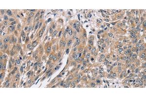 Immunohistochemistry of paraffin-embedded Human lung cancer using PPP1CC Polyclonal Antibody at dilution of 1:40 (PPP1CC Antikörper)