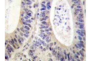 Immunohistochemistry analyzes of p47-phox antibody in paraffin-embedded human colon carcinoma tissue. (NCF1 Antikörper)