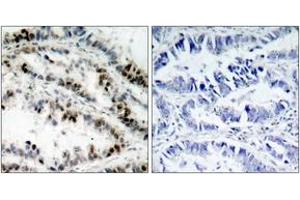 Immunohistochemistry analysis of paraffin-embedded human lung carcinoma, using SMC1 (Phospho-Ser957) Antibody. (SMC1A Antikörper  (pSer957))