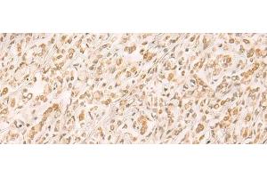 Immunohistochemistry of paraffin-embedded Human gastric cancer tissue using SETD1A Polyclonal Antibody at dilution of 1:25(x200) (SETD1A Antikörper)