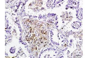 Formalin-fixed and paraffin embedded human lung carcinoma labeled with Anti-DKK3 Polyclonal Antibody, Unconjugated (ABIN749123) followed by conjugation to the secondary antibody and DAB staining (DKK3 Antikörper  (AA 31-130))