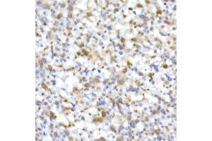 Immunohistochemistry of paraffin-embedded Undifferentiated carcinoma of human esophagus using SM/SNF5 Rabbit pAb  at dilution of 1:250 (40x lens). (SMARCB1 Antikörper  (AA 77-376))