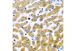 Immunohistochemical analysis of MDH2 staining in human liver cancer formalin fixed paraffin embedded tissue section. (MDH2 Antikörper)