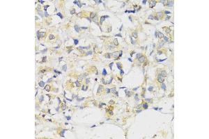 Immunohistochemistry of paraffin-embedded human breast cancer using MLKL antibody (ABIN6134395, ABIN6143882, ABIN6143886 and ABIN6217454) at dilution of 1:100 (40x lens). (MLKL Antikörper  (C-Term))