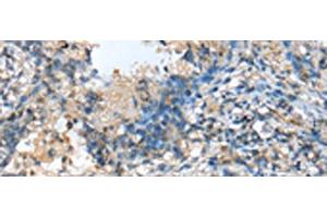 Immunohistochemistry of paraffin-embedded Human lung cancer tissue using MOB4 Polyclonal Antibody at dilution of 1:25(x200)