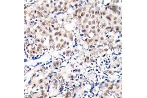 Immunohistochemistry of paraffin-embedded human breast carcinoma tissue, using Phospho-CDKN1B-T187 antibody (ABIN2987947). (CDKN1B Antikörper  (pThr187))