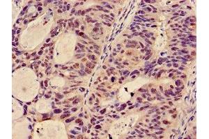 Immunohistochemistry of paraffin-embedded human colon cancer using ABIN7145363 at dilution of 1:100 (GCNT3 Antikörper  (AA 250-419))