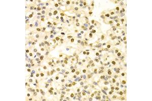 Immunohistochemistry of paraffin-embedded human kidney cancer using HDGF Antibody (ABIN1876535) at dilution of 1:100 (40x lens). (HDGF Antikörper)