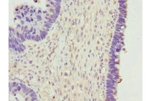 Immunohistochemistry of paraffin-embedded human ovarian cancer using ABIN7145624 at dilution of 1:100 (BPGM Antikörper  (AA 1-259))