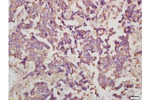 Formalin-fixed and paraffin embedded human lung carcinoma labeled with Rabbit Anti-Myosin VIIa Polyclonal Antibody, Unconjugated  at 1:200 followed by conjugation to the secondary antibody and DAB staining (Myosin VIIA Antikörper  (AA 851-950))