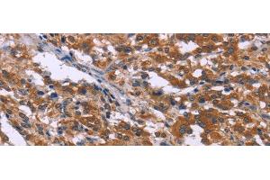 Immunohistochemistry of paraffin-embedded Human thyroid cancer tissue using SKI Polyclonal Antibody at dilution 1:40 (SKI Antikörper)