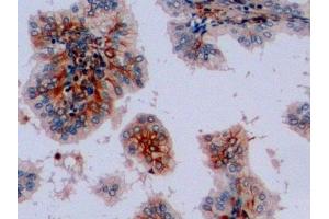 Detection of VIM in Human Prostate Tissue using Polyclonal Antibody to Vimentin (VIM) (Vimentin Antikörper  (AA 2-466))