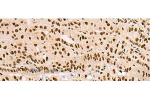 Immunohistochemistry of paraffin-embedded Human thyroid cancer tissue using XRCC4 Polyclonal Antibody at dilution of 1:60(x200) (XRCC4 Antikörper)