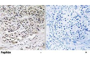 Immunohistochemistry analysis of paraffin-embedded human breast carcinoma tissue using AZI1 polyclonal antibody . (AZI1 Antikörper)