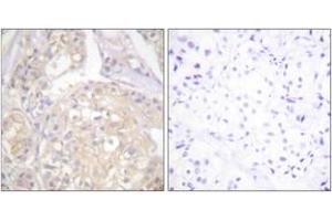 Immunohistochemistry analysis of paraffin-embedded human breast carcinoma, using FGFR1 (Phospho-Tyr766) Antibody. (FGFR1 Antikörper  (pTyr766))