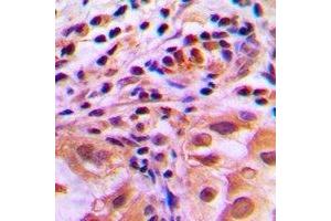 Immunohistochemical analysis of FOXO1 (pS256) staining in human lung cancer formalin fixed paraffin embedded tissue section. (FOXO1 Antikörper  (pSer256))