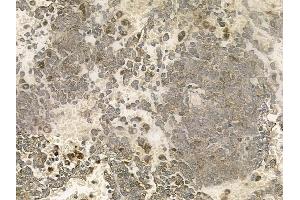 ABIN6261003 and ABIN6273036 at 1/100 staining human melanoma by IHC-P. (Complexin 1 Antikörper  (N-Term))