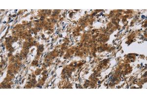 Immunohistochemistry of paraffin-embedded Human gastic cancer using IL17RB Polyclonal Antibody at dilution of 1:40 (IL17 Receptor B Antikörper)