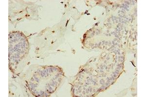 Immunohistochemistry of paraffin-embedded human breast cancer using ABIN7157312 at dilution of 1:100 (KEL Antikörper  (AA 201-500))