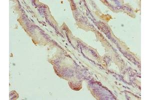 Immunohistochemistry of paraffin-embedded human prostate cancer using ABIN7161014 at dilution of 1:100