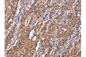 The image on the left is immunohistochemistry of paraffin-embedded Human gastic cancer tissue using ABIN7190999(HRASLS2 Antibody) at dilution 1/20, on the right is treated with synthetic peptide. (HRASLS2 Antikörper)