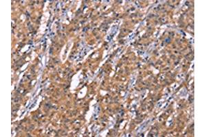 The image on the left is immunohistochemistry of paraffin-embedded Human gastic cancer tissue using ABIN7190999(HRASLS2 Antibody) at dilution 1/20, on the right is treated with synthetic peptide.