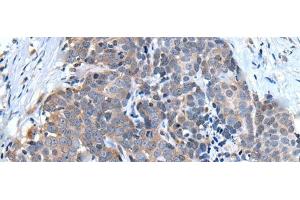 Immunohistochemistry of paraffin-embedded Human thyroid cancer tissue using UBQLN2 Polyclonal Antibody at dilution of 1:45(x200) (Ubiquilin 2 Antikörper)