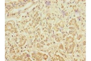 Immunohistochemistry of paraffin-embedded human pancreatic cancer using ABIN7167095 at dilution of 1:100 (RanBP3 Antikörper  (AA 1-250))
