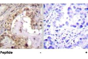 Immunohistochemical analysis of paraffin-embedded human lung carcinoma tissue using BCL2L1 polyclonal antibody . (BCL2L1 Antikörper)