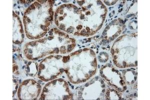 Immunohistochemical staining of paraffin-embedded Adenocarcinoma of ovary tissue using anti-LIPG mouse monoclonal antibody. (LIPG Antikörper)
