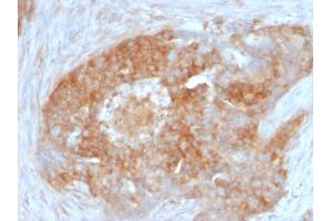 Immunohistochemistry (IHC) image for anti-Fascin (FSCN1) antibody (ABIN6940607)