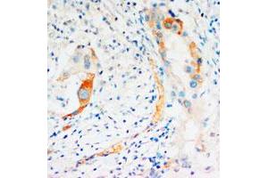 Immunohistochemical staining of CASP2 on formalin fixed, paraffin embedded human mammary cancer with CASP2 polyclonal antibody . (Caspase 2 Antikörper  (C-Term))