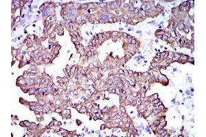Immunohistochemical analysis of paraffin-embedded endometrial cancer tissues using CK5 mouse mAb with DAB staining. (Cytokeratin 5 Antikörper  (AA 316-590))