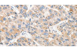 Immunohistochemistry of paraffin-embedded Human liver cancer tissue using ANAPC2 Polyclonal Antibody at dilution 1:30 (ANAPC2 Antikörper)