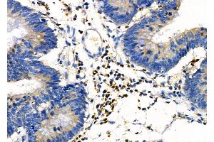 ABIN6257267 and ABIN6274157 at 1/100 staining Human colorectal cancer by IHC-P. (Homeobox C6 Antikörper  (N-Term))