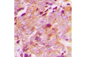 Immunohistochemical analysis of CEP76 staining in human breast cancer formalin fixed paraffin embedded tissue section. (Cep76 Antikörper)