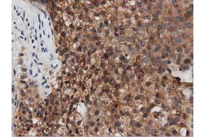 Immunohistochemical staining of paraffin-embedded Carcinoma of Human pancreas tissue using anti-PEPD mouse monoclonal antibody. (PEPD Antikörper)