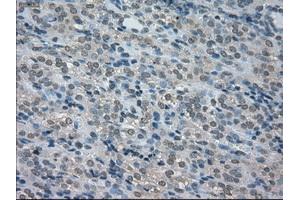 Immunohistochemical staining of paraffin-embedded Carcinoma of thyroid tissue using anti-BUB1Bmouse monoclonal antibody. (BUB1B Antikörper)