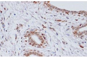Immunohistochemistry of paraffin-embedded Human breast cancer using TriMethyl-Histone H3-K27 Polyclonal Antibody at dilution of 1:100 (40x lens). (Histone 3 Antikörper  (3meLys27))