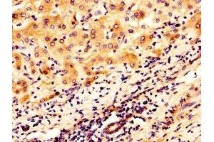 IHC image of ABIN7159817 diluted at 1:300 and staining in paraffin-embedded human liver cancer performed on a Leica BondTM system. (OGN Antikörper  (AA 21-298))