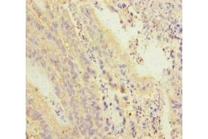 Immunohistochemistry of paraffin-embedded human colon cancer using ABIN7168417 at dilution of 1:100 (PDE6A Antikörper  (AA 656-860))