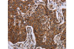 Immunohistochemistry of Human liver cancer using ACP6 Polyclonal Antibody at dilution of 1:30 (ACP6 Antikörper)