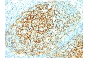 Formalin-fixed, paraffin-embedded human Tonsil stained with CD106 Monoclonal Antibody (1. (VCAM1 Antikörper)