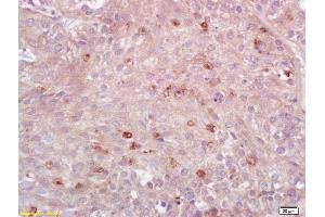 Formalin-fixed and paraffin embedded human lung carcinoma labeled with Anti-MHC Class II/HLA-DPB1 Polyclonal Antibody, Unconjugated (ABIN753928) at 1:200 followed by conjugation to the secondary antibody and DAB staining.