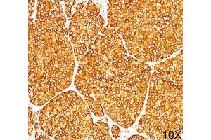 IHC staining of melanoma tissue (10X) with Tyrosinase antibody (T311).