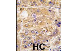 Formalin-fixed and paraffin-embedded human hepatocellular carcinoma reacted with LDLRAP1 polyclonal antibody  , which was peroxidase-conjugated to the secondary antibody, followed by DAB staining. (LDLRAP1 Antikörper  (C-Term))