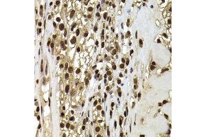Immunohistochemistry of paraffin-embedded human kidney cancer using ACTL6B antibody at dilution of 1:100 (x400 lens).