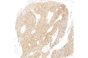 Immunohistochemistry (IHC) image for anti-Metadherin (MTDH) (AA 475-525) antibody (ABIN7795651) (Rekombinanter MTDH Antikörper  (AA 475-525))